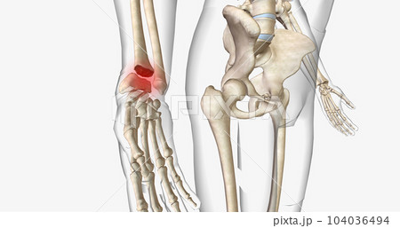 Distal radius fractures are among the most common types of fractures and are most common in the upper extremities. 104036494