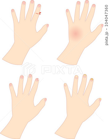 荒れた女性の手4種類セット_1 104047360