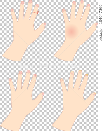 荒れた女性の手4種類セット_1 104047360