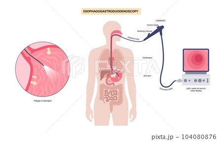 Gastroscopy endoscopy procedure 104080876