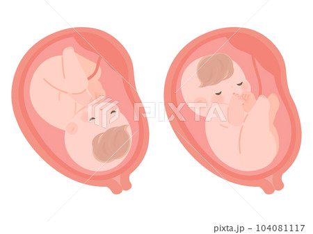 通常と逆子の赤ちゃんの子宮内イラスト 104081117