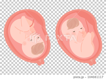 Intrauterine illustration of normal and breech babies 104081117