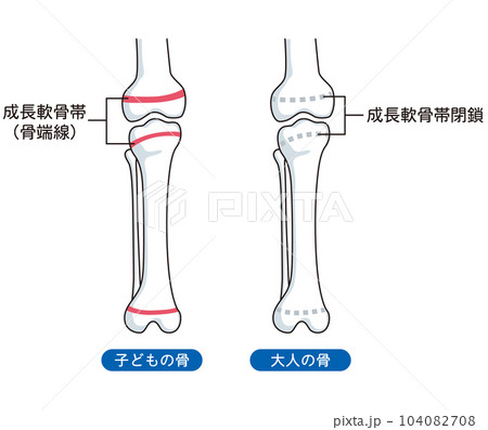 骨端線　子どもの骨と、大人の骨 104082708