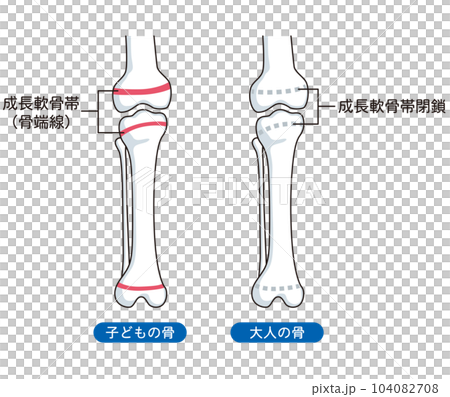 骨端線　子どもの骨と、大人の骨 104082708