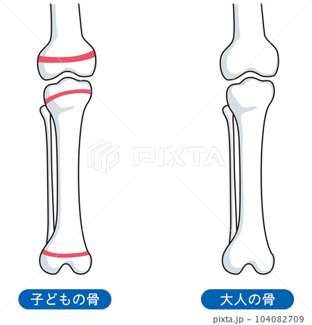 骨端線　子どもの骨と、大人の骨 104082709