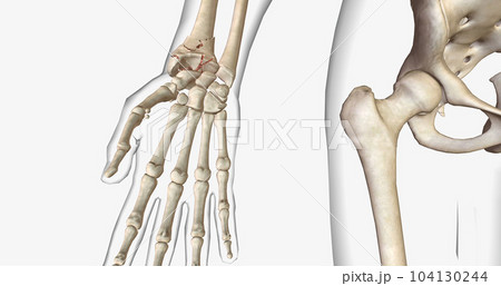 A fracture, often referred to as a broken bone, is an acute injury that causes a partial or complete break through bone. A fracture, often referred to as a broken bone, is an acute injury that causes a partial or complete break through bone. 104130244