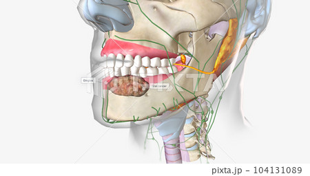 Once a tumor has spread into nearby lymph nodes, it is considered a stage three cancer. 104131089