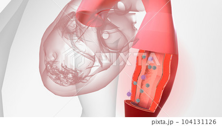 High volumes of lymphocytes, macrophages, and other immune cells infiltrate the inflamed aorta. High volumes of lymphocytes, macrophages, and other immune cells infiltrate the inflamed aorta. 104131126