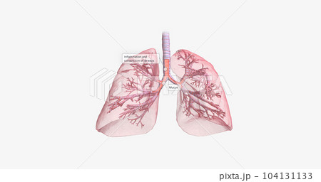 Inflammation and constriction of airways 104131133