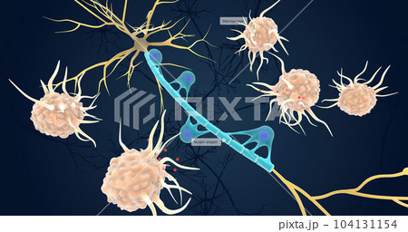 Autoimmune Attack on Myelin Sheath 104131154