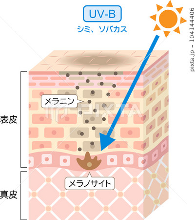 紫外線 UV-B 肌の立体断面図 紫外線 UV-B 肌の立体断面図 104144406