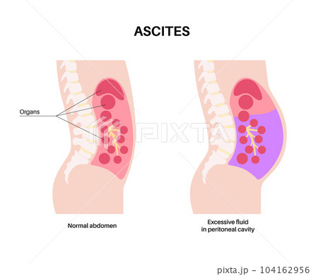 Ascites disease poster Ascites disease poster 104162956