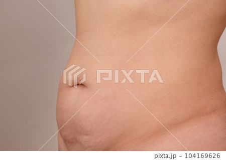 Cropped woman torso with sagging and bloated belly on grey background Cropped woman torso with sagging and bloated belly on grey background 104169626
