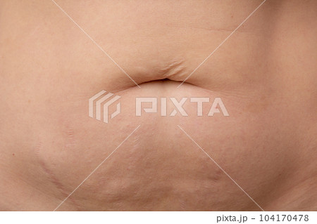 Post-pregnancy belly button altered due to an umbilical hernia or stretched skin overhanging belly button on cropped body Post-pregnancy belly button altered due to an umbilical hernia or stretched skin overhanging belly button on cropped body 104170478