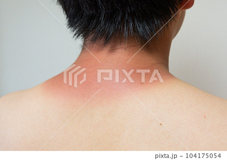 痛みを伴うひどい日焼けの男性 痛みを伴うひどい日焼けの男性 104175054