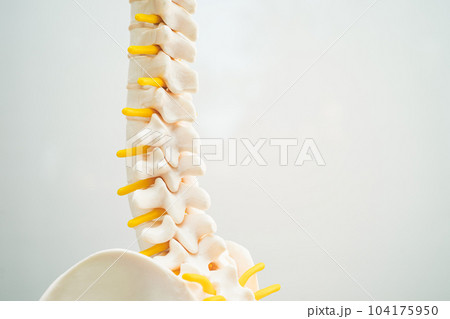 Lumbar spine displaced herniated disc fragment, spinal nerve and bone. Model for treatment medical in the orthopedic department. 104175950