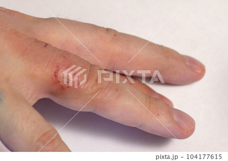 Hand dermatitis. Hand eczema closed on white background Hand dermatitis. Hand eczema closed on white background 104177615
