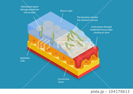 3D Isometric Flat Vector Conceptual Illustration of Peptic Ulcer 104178613