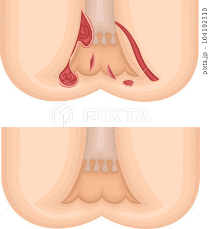 肛門 痔 イラスト 肛門 痔 イラスト 104192319