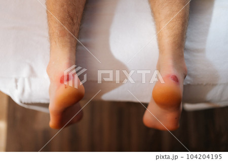 Close-up top view feet with calluses on heels of unrecognizable man lying down on massage table in luxury spa salon. Close up cropped shot of painful wound on mans feet caused by new shoes. Close-up top view feet with calluses on heels of unrecognizable man lying down on massage table in luxury spa salon. Close up cropped shot of painful wound on mans feet caused by new shoes. 104204195