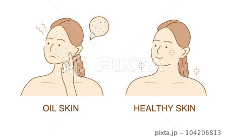 Acne skin with black dots. Face with pimples, acne. Teenager skin. The girl worries about unhealthy skin of her face. Skincare and dermatology. 104206813