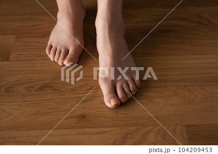 Hallux valgus on female legs on the background of laminate flooring. A bump on a woman's legs close-up. Hallux valgus on female legs on the background of laminate flooring. A bump on a woman's legs close-up. 104209453