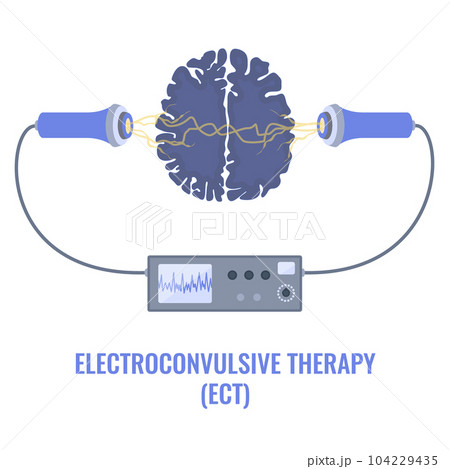 ECT electroconvulsive therapy for severe depression treatment 104229435