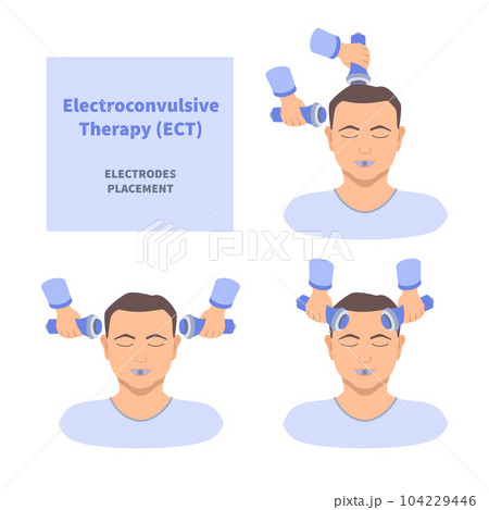 ECT electroconvulsive therapy for severe depression treatment ECT electroconvulsive therapy for severe depression treatment 104229446