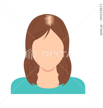 女性のびまん性脱毛症 ベクターイラスト (顔なし) 女性のびまん性脱毛症 ベクターイラスト (顔なし) 104229671