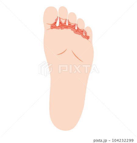 水虫　趾間型 104232299