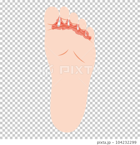 水虫　趾間型 104232299