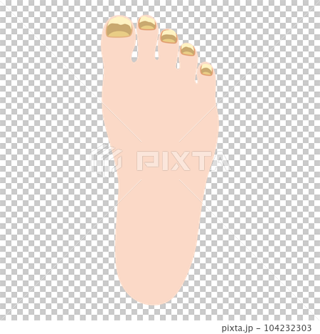 Athlete's foot Tinea unguium 104232303