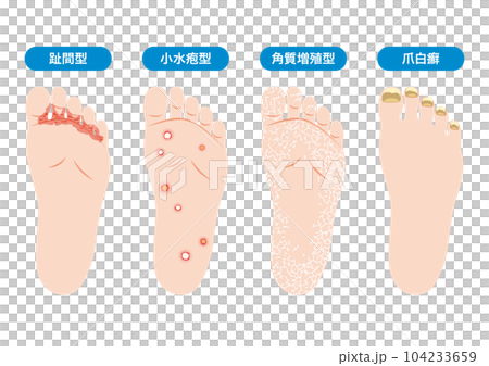 水虫の種類 104233659