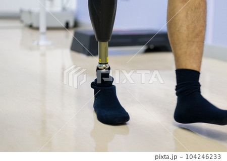 Prosthesis after foot injury and impairment treat 104246233