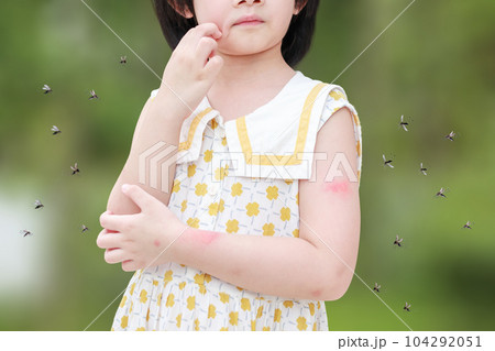 Little girl has skin rash allergy itching and scratching on her arm with mosquitoes bite Little girl has skin rash allergy itching and scratching on her arm with mosquitoes bite 104292051