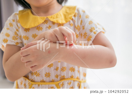 Little girl has skin rash allergy itching and scratching on her arm 104292052