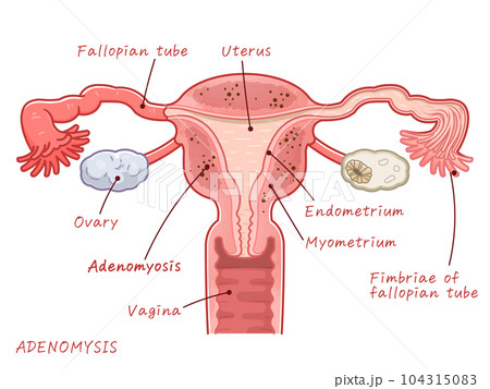 子宮、adenomyosis of uterus、ovary、uterus、illustration 子宮、adenomyosis of uterus、ovary、uterus、illustration 104315083