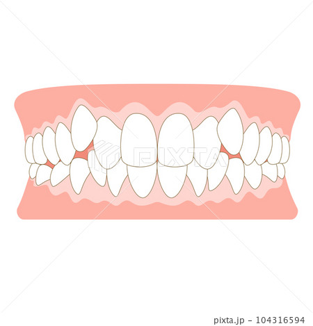 八重歯の歯並び 八重歯の歯並び 104316594