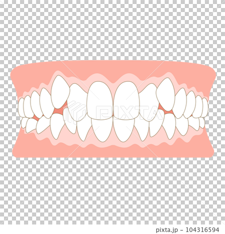 八重歯の歯並び 八重歯の歯並び 104316594