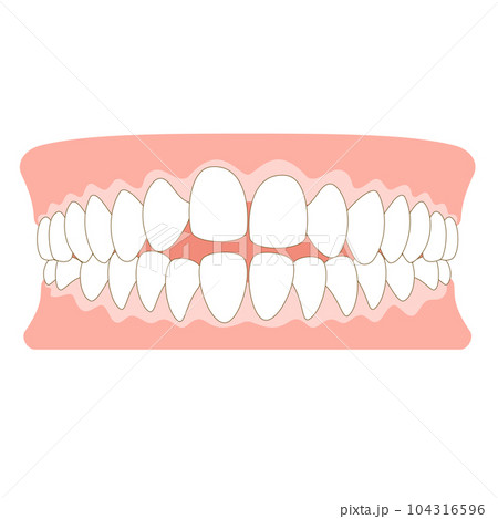 オープンバイトの歯並び 104316596