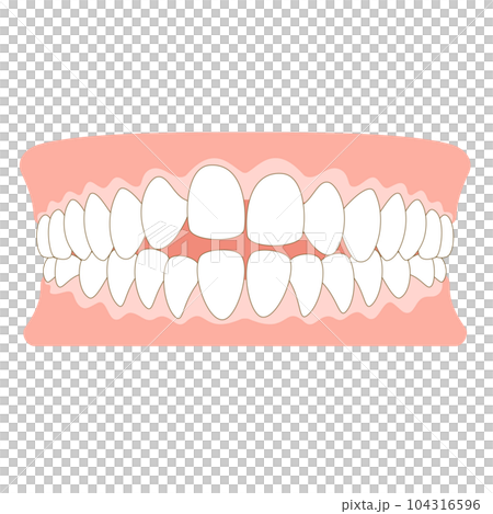 オープンバイトの歯並び 104316596