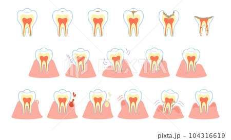 虫歯の進行と歯茎の症状セット 104316619