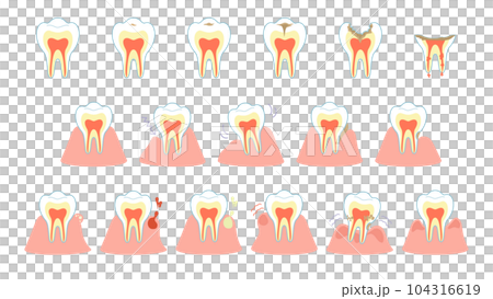 虫歯の進行と歯茎の症状セット 104316619