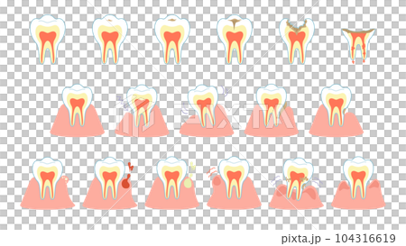 Caries progression and gum symptoms set 104316619