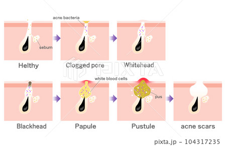 Progression of acne 104317235
