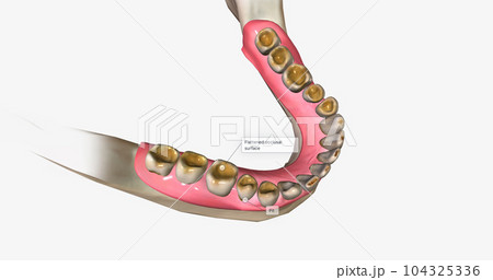 Dental erosion, also known as tooth erosion Dental erosion, also known as tooth erosion 104325336