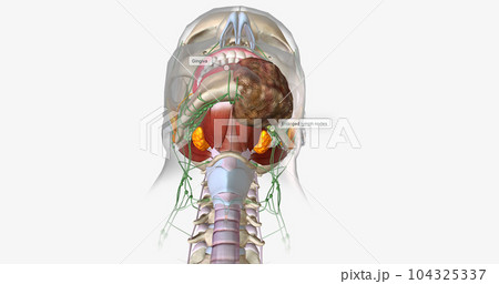 Stage four oral cancer is invasive and has spread beyond the tissue in which it first appeared. Stage four oral cancer is invasive and has spread beyond the tissue in which it first appeared. 104325337
