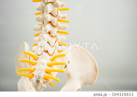 Lumbar spine displaced herniated disc fragment, spinal nerve and bone. Model for treatment medical in the orthopedic department. Lumbar spine displaced herniated disc fragment, spinal nerve and bone. Model for treatment medical in the orthopedic department. 104328813