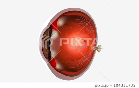 Pars planitis is an eye disease where the middle layer of the eye, called the uvea, becomes inflamed Pars planitis is an eye disease where the middle layer of the eye, called the uvea, becomes inflamed 104331735