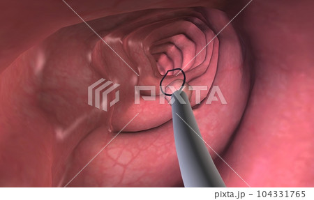 Colonoscopy is a procedure that allows you to see inside your entire large intestine. Colonoscopy is a procedure that allows you to see inside your entire large intestine. 104331765